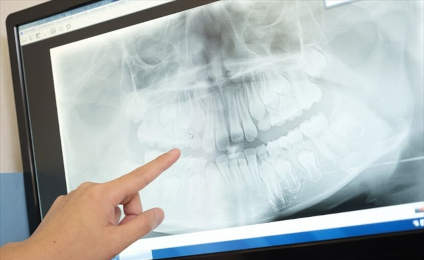 骨吸収抑制剤の副作用が怖い 顎骨壊死との関連