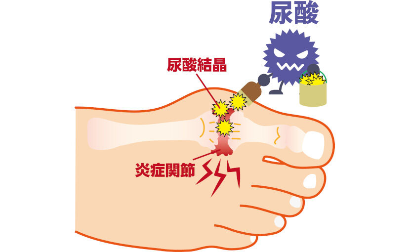 偽痛風の症状は何ですか?